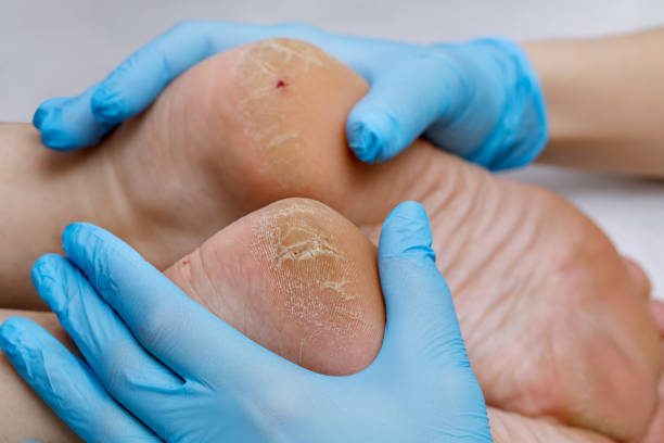 Ošetření diabetické nohy